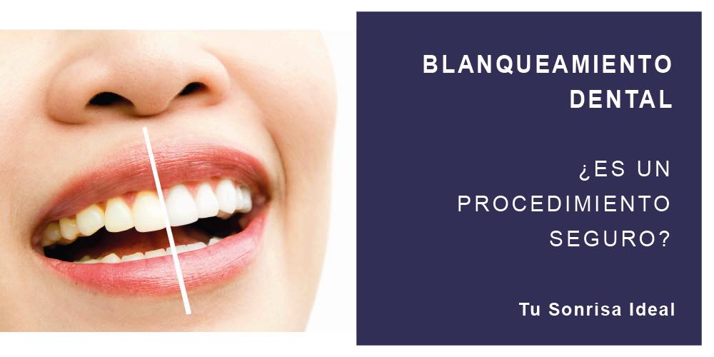 ¿El blanqueamiento dental es seguro?