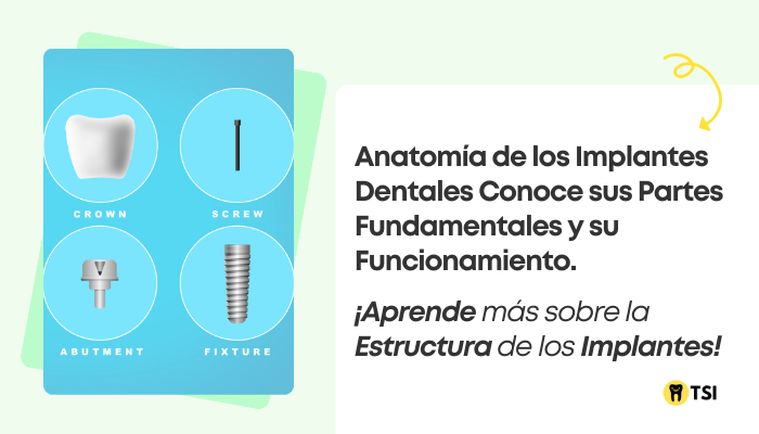 Partes de los implantes dentales: Clasificación y otros datos importantes