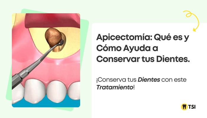 apicectomia que es y como ayuda a conservar tus dientes