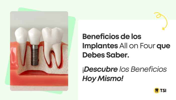 Implantes All On Four: Todo Lo Que Necesitas Saber Sobre Este tratamiento