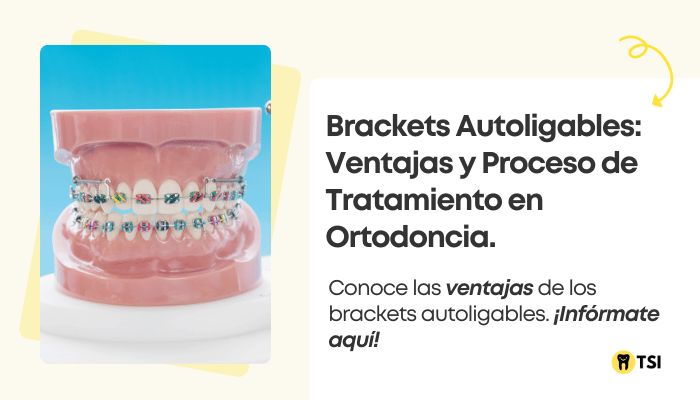 brackets autoligables ventajas y proceso de tratamiento en ortodoncia