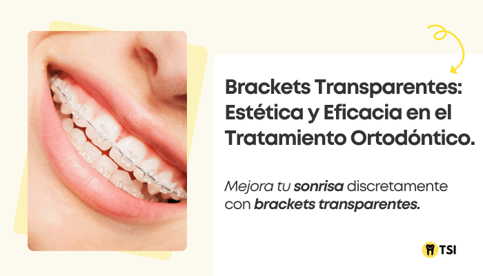 brackets transparentes estetica y eficacia en el tratamiento ortodontico