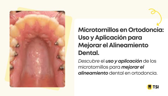 microtornillos en ortodoncia uso y aplicacion para mejorar el alineamiento dental