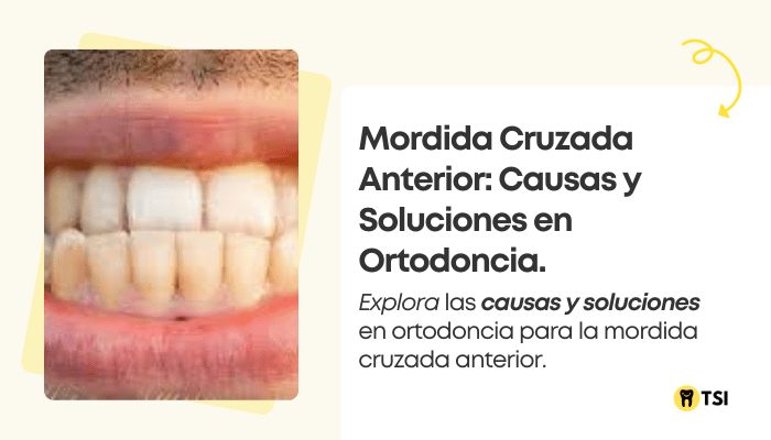 mordida cruzada anterior causas y soluciones en ortodoncia